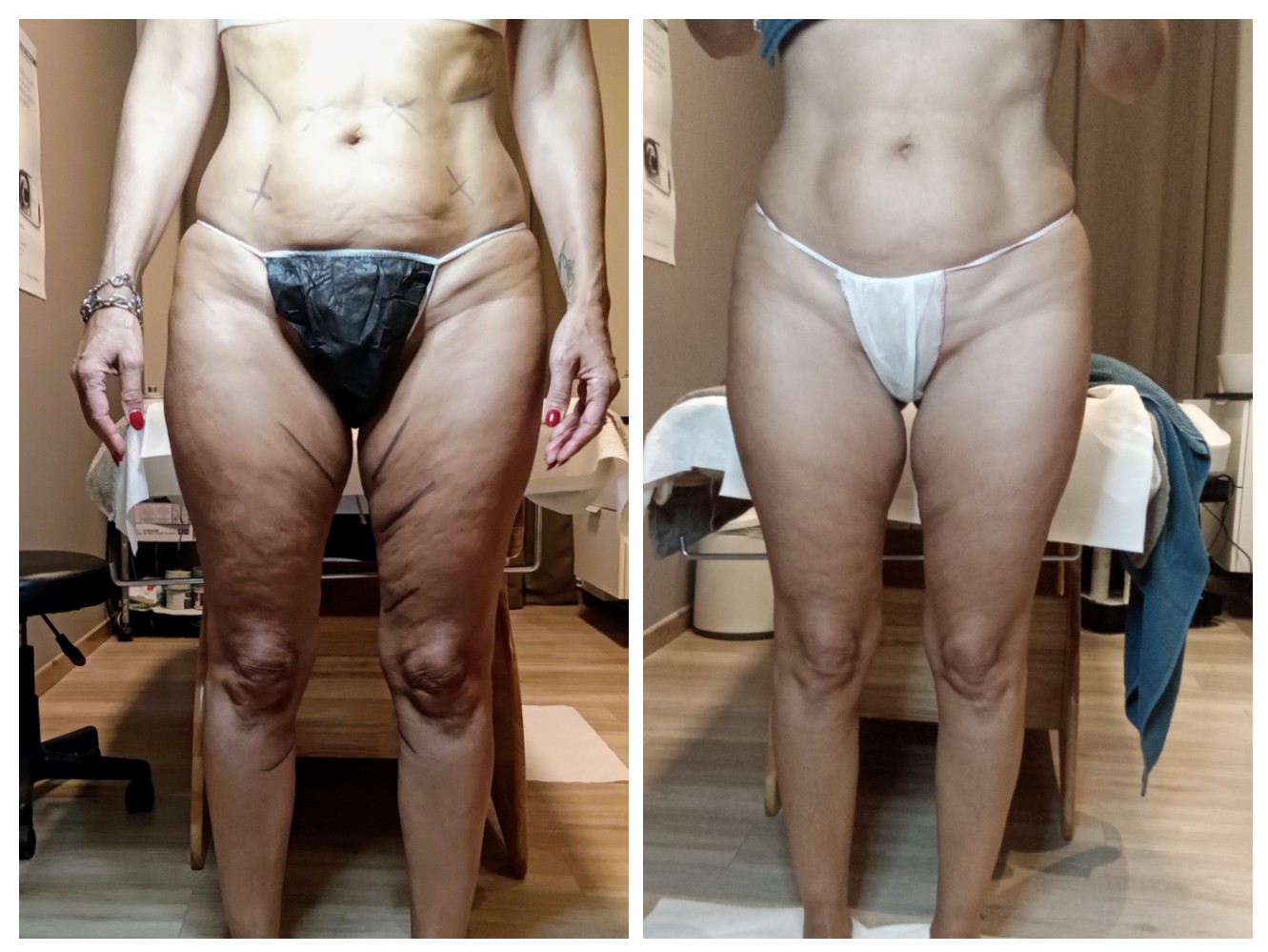 Risultato prima e dopo di Laura: Gambe rimodellate con il protocollo NEW SKIN