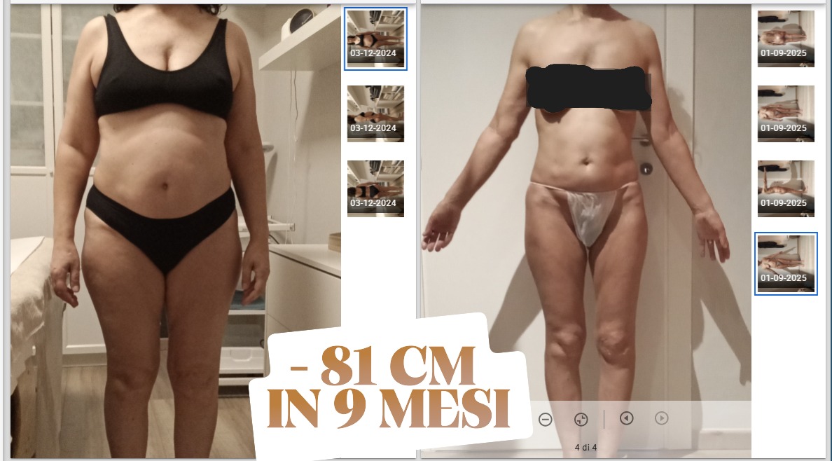 Risultato prima e dopo di Lara: −81 cm in 9 mesi con il protocollo NEW SKIN